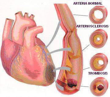 El Médico Práctico: Cardiopatía isquémica