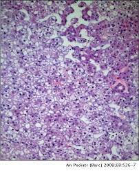 Adenomatosis..jpg