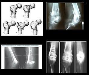 Fractura del extremo distal del fémur EcuRed