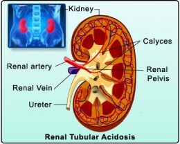 Acidosis renal.jpeg