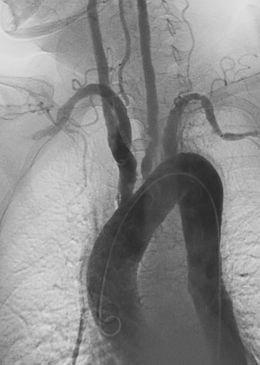 Takayasu Arteritis.jpg