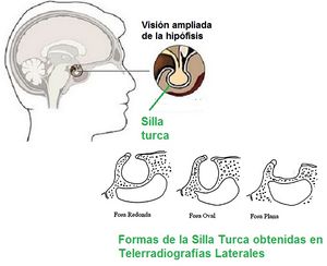 Hipofisis y silla turca.jpg