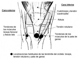 Tendinitis2.JPG