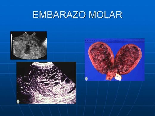 Embarazo Molar Ecured 