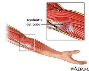 Tendinitis del codo 19632.jpg