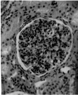 Glomerulonefritis membranoproliferativa.png