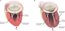 Insuficiencia Valvular.jpg