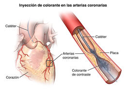 Angioplastiahgdgdgdoiy8.jpg