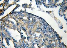 Tumor-ginecológico (Small).jpg