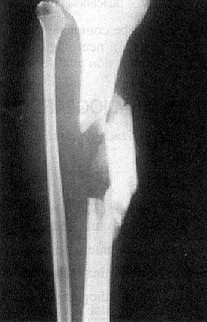 Fractura-diáfisis-de-la-tibia-176b (Small).jpg