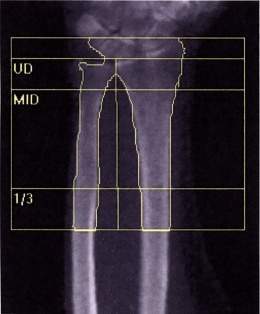 Densitometria-osea-01.jpg