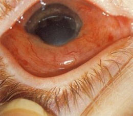 Hemorragia subconjuntival.JPG