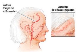 Arteritis.jpg