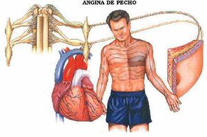 Angina pecho.jpg