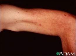 Telangiectasias-upper-arm.jpg