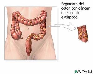 Cáncer del colon.jpg